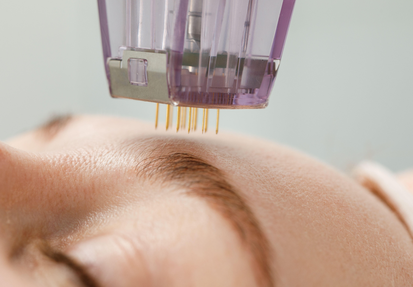 RF Microneedling 1