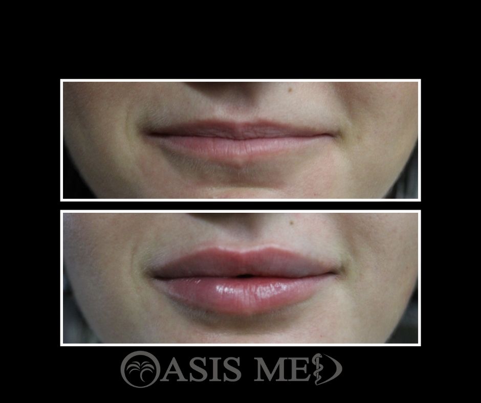 before after 22