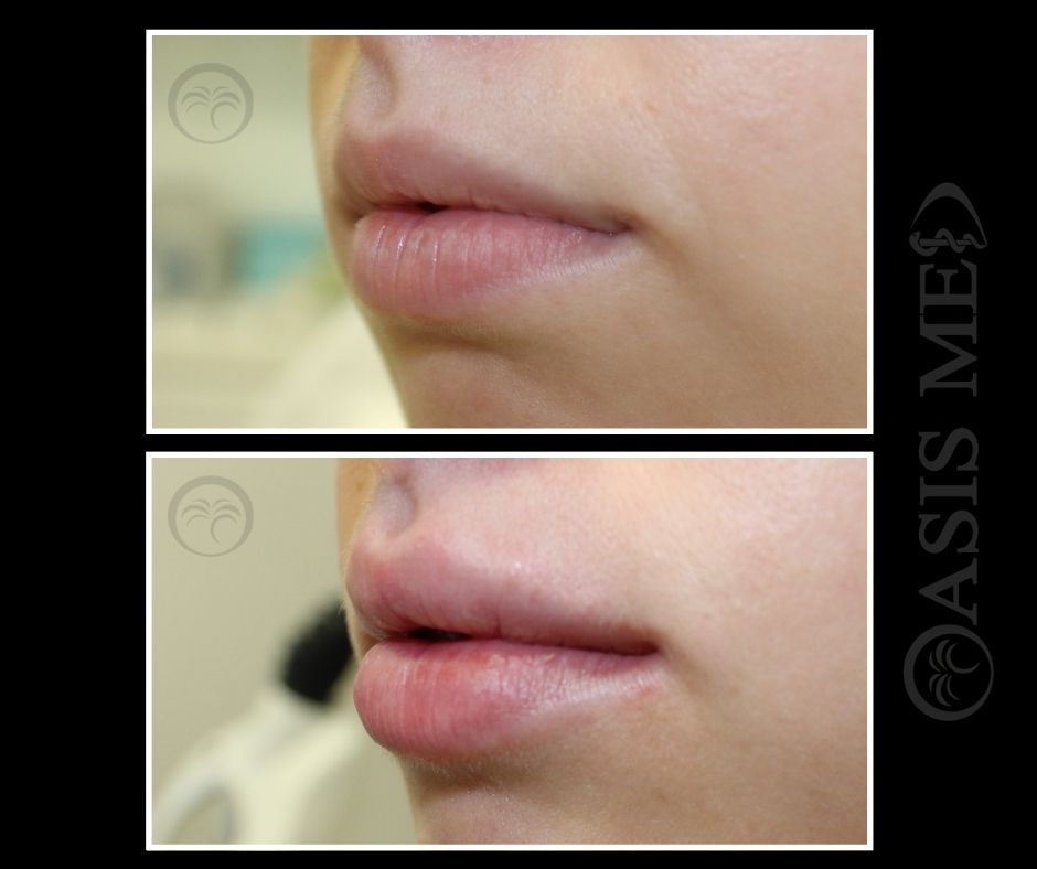 before after 23