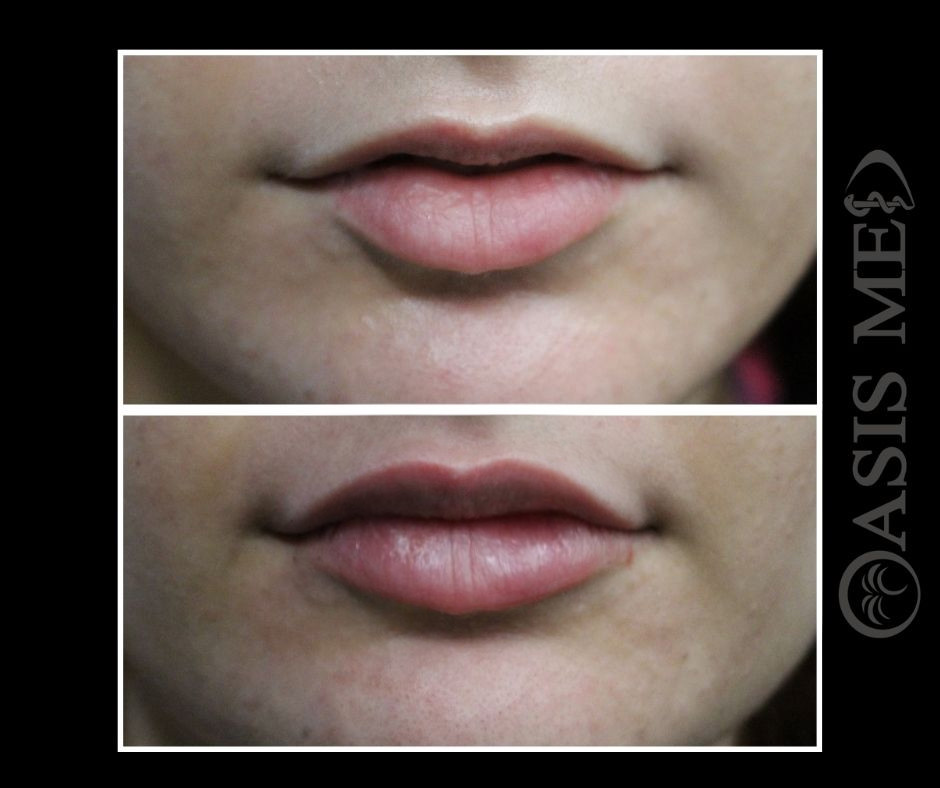 before after 24