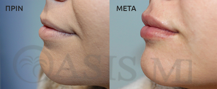 before after 9