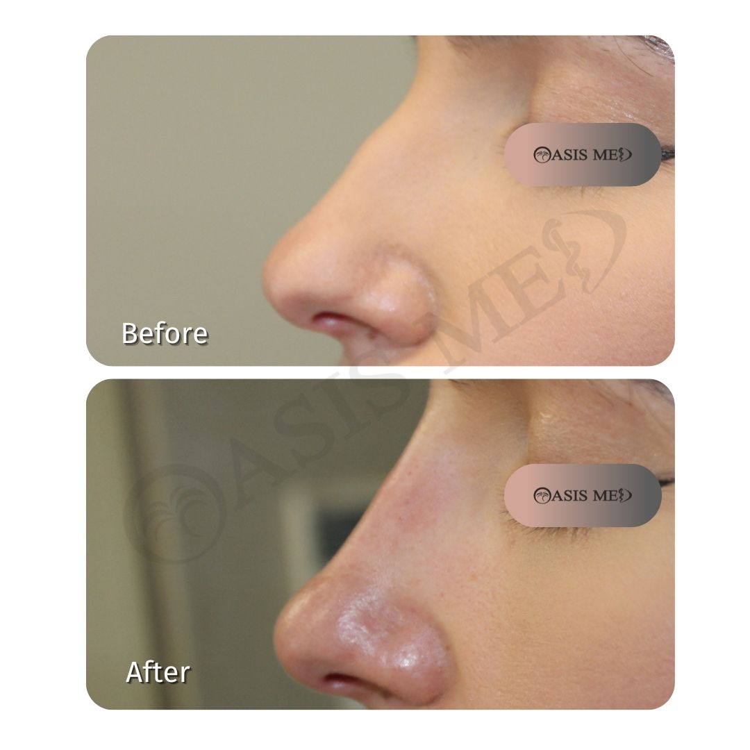 before after 14