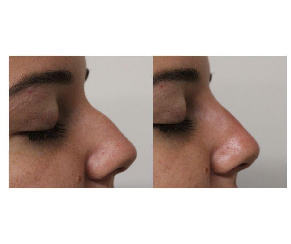 before after 17