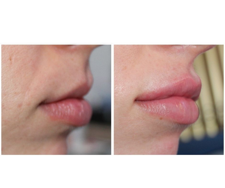 before after 34