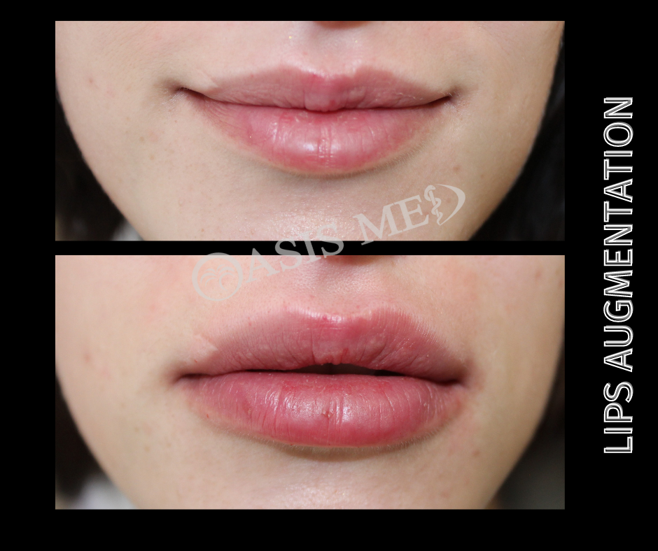 before after 33
