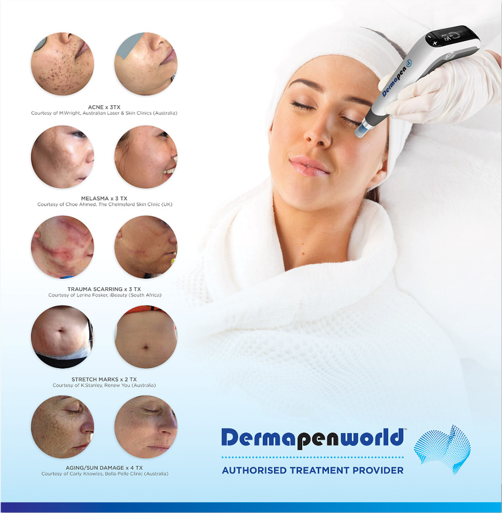 Dermapen 4™ η εξέλιξη του κλασσικού microneedling 4