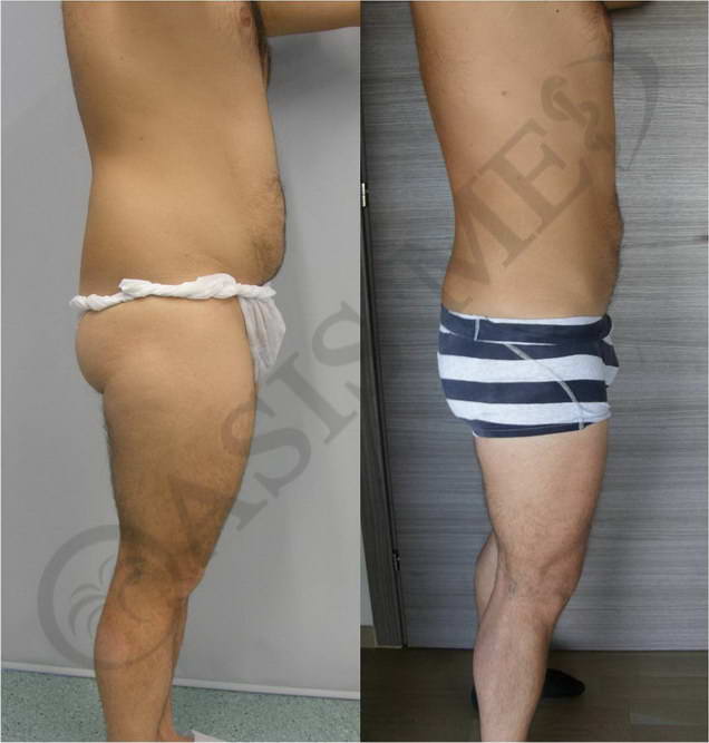 before after 11