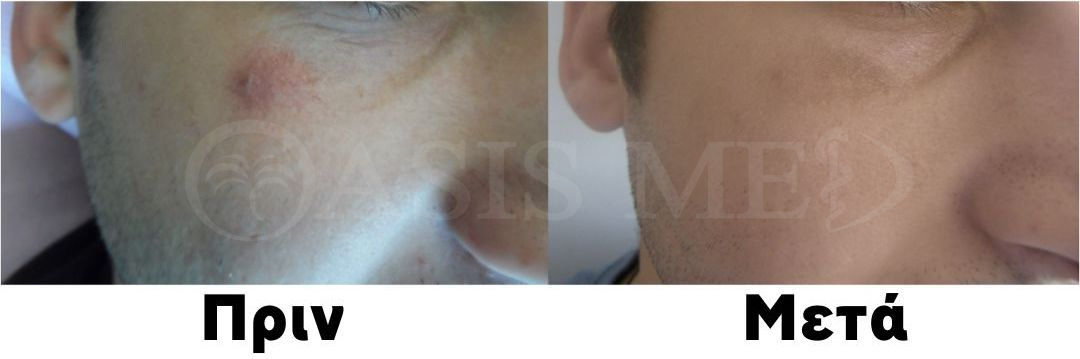 before after 1