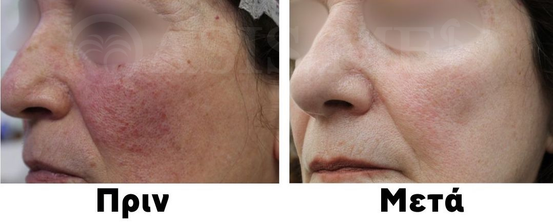 before after 0