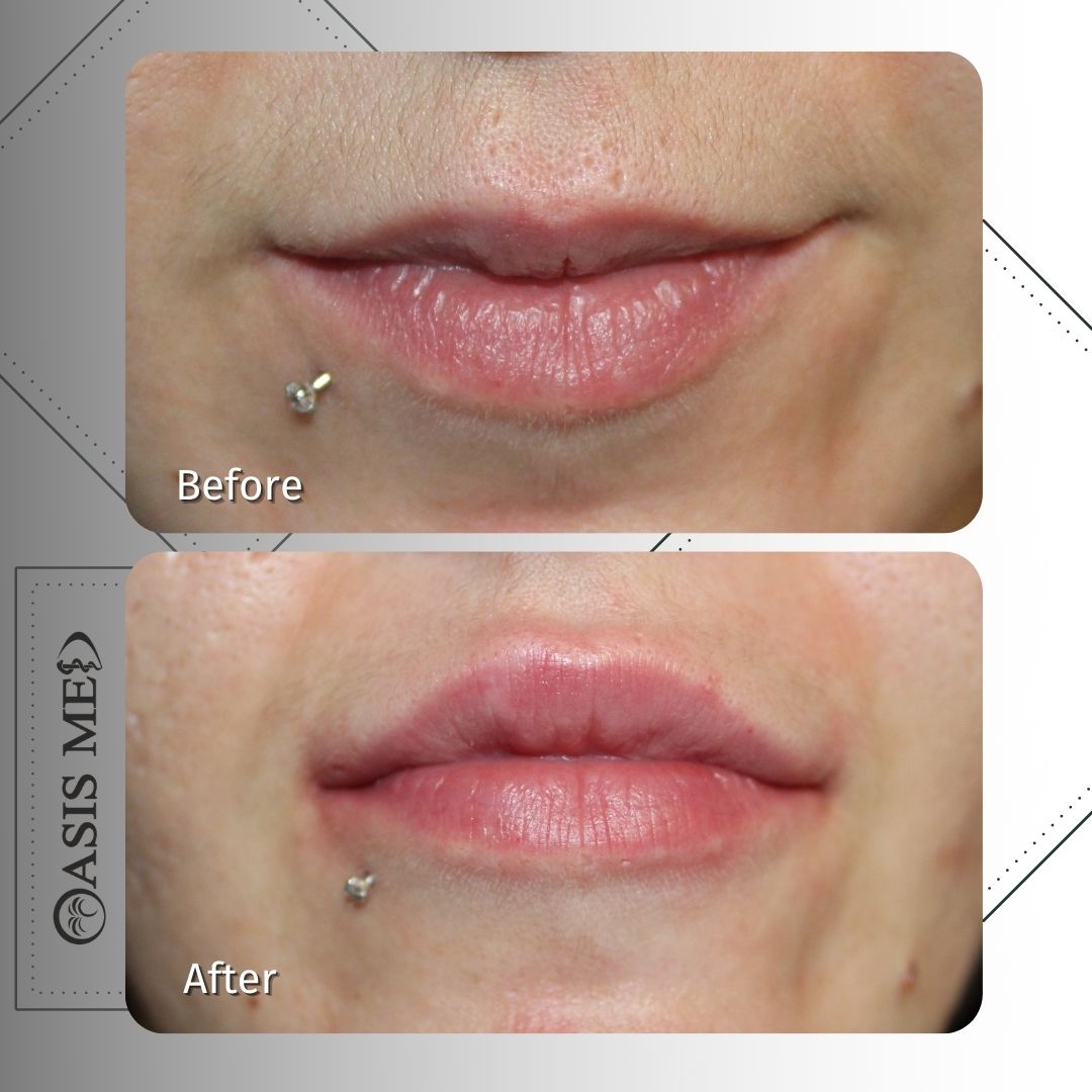 before after 25