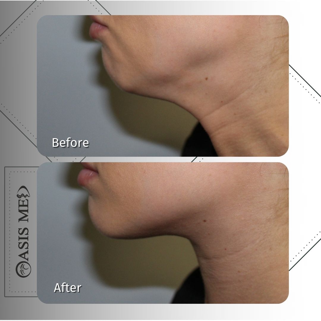 before after 1