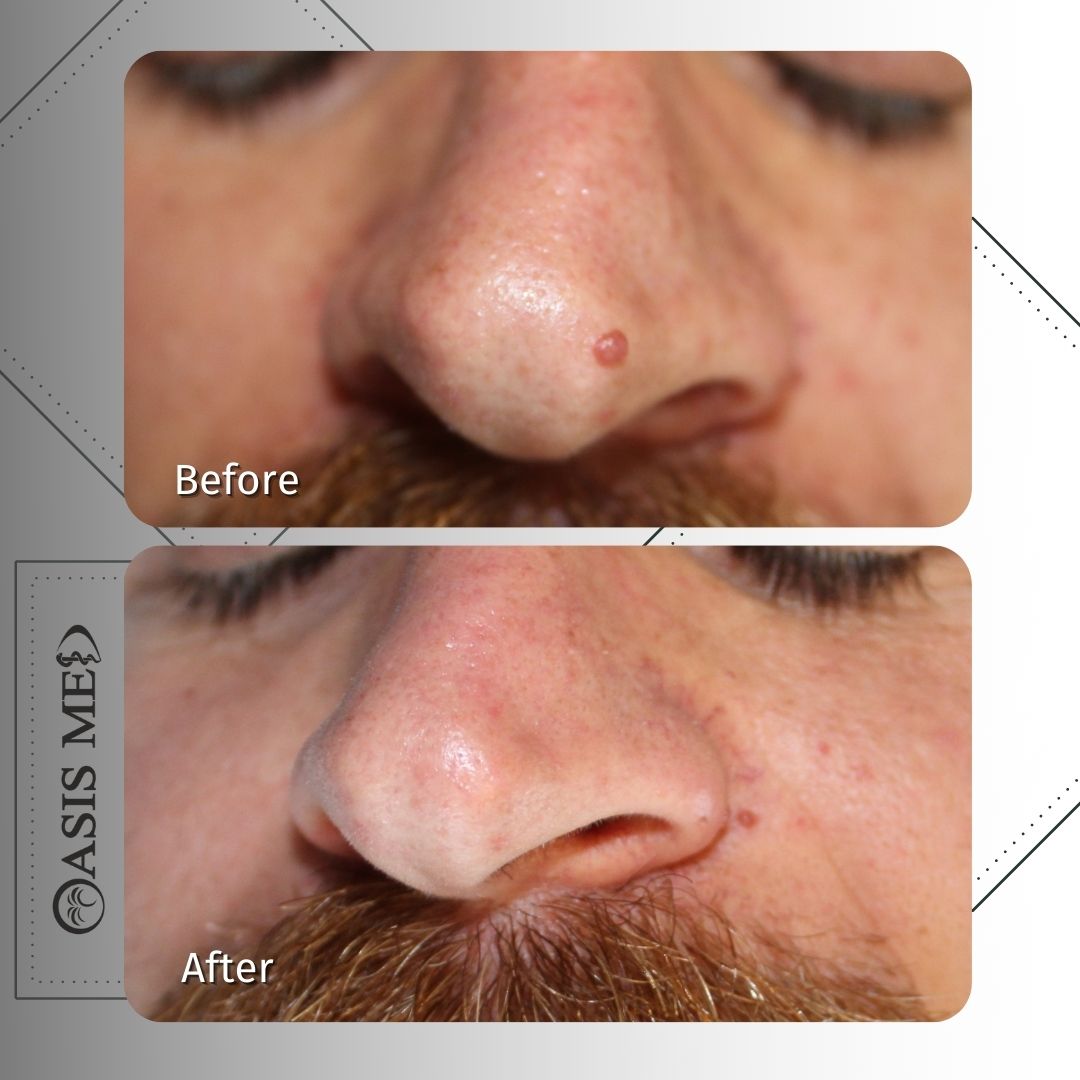 before after 11