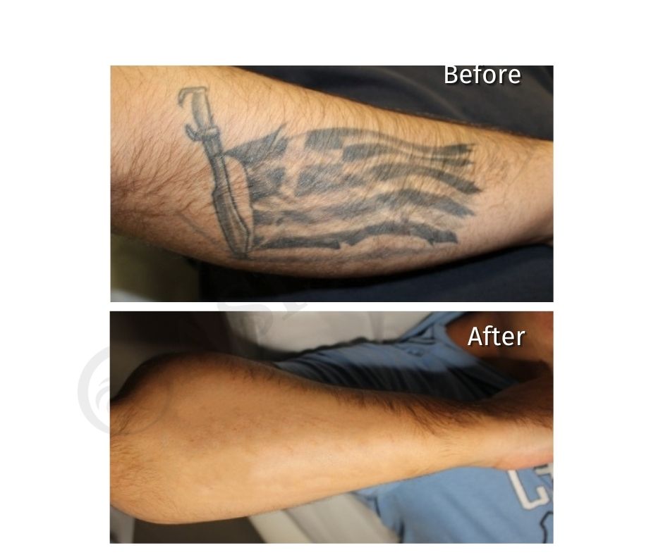 before after 10