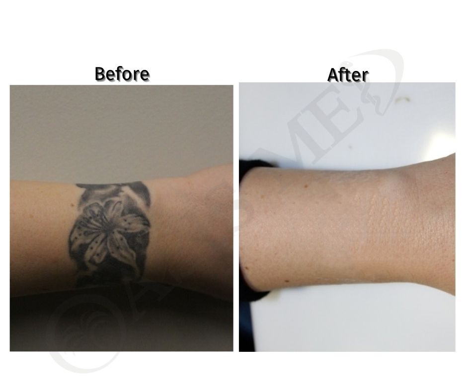 before after 12