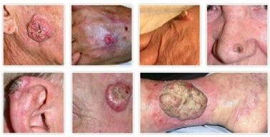 Καρκίνων του Δέρματος  5