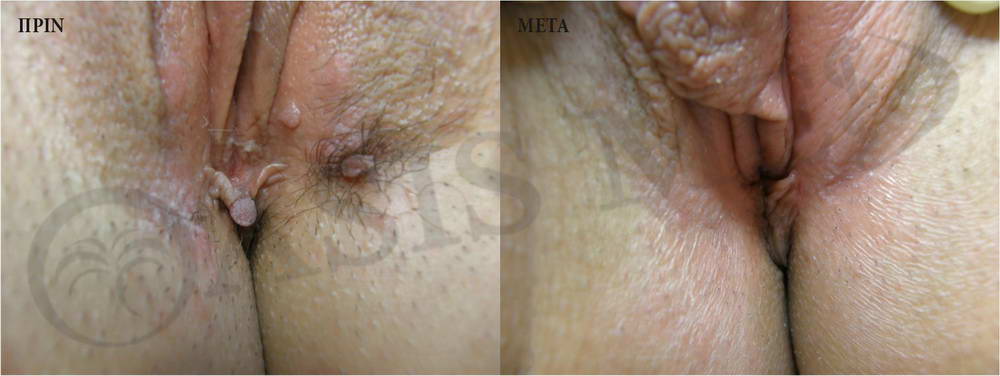 before after 2