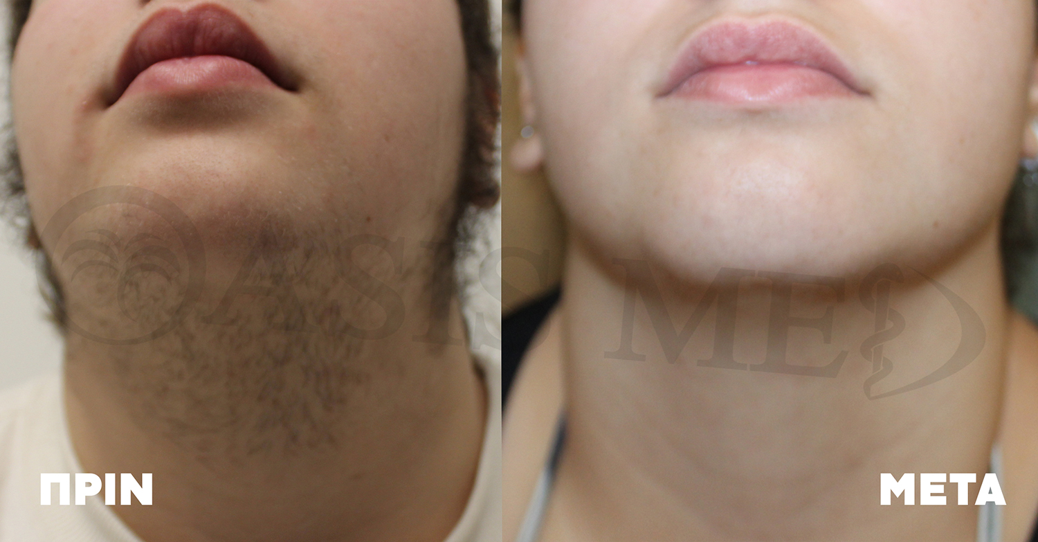 before after 0