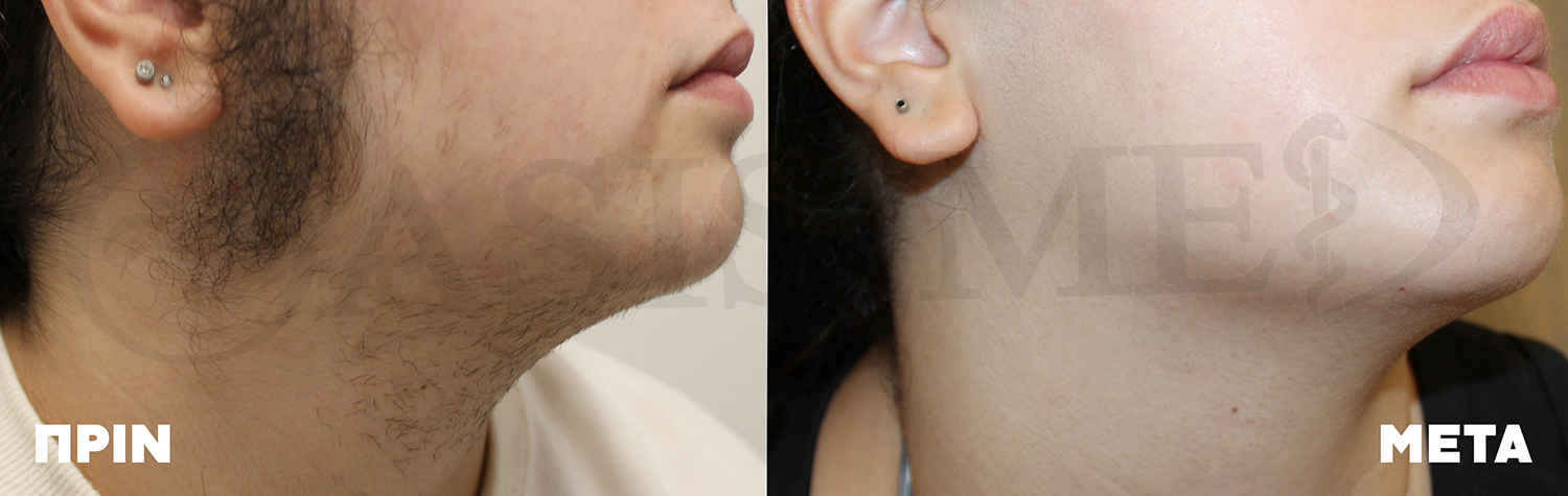 before after 1