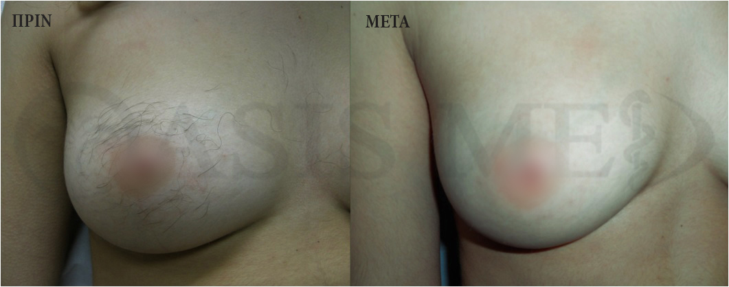 before after 11