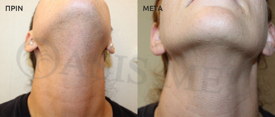 before after 5