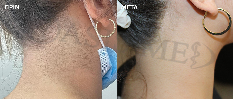 before after 2