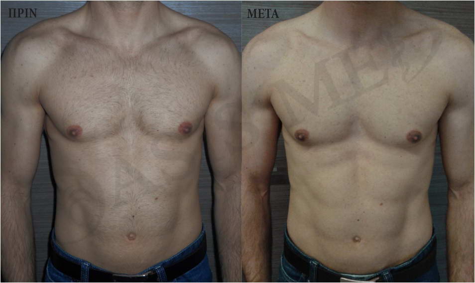 before after 5