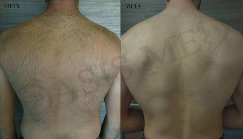 before after 6