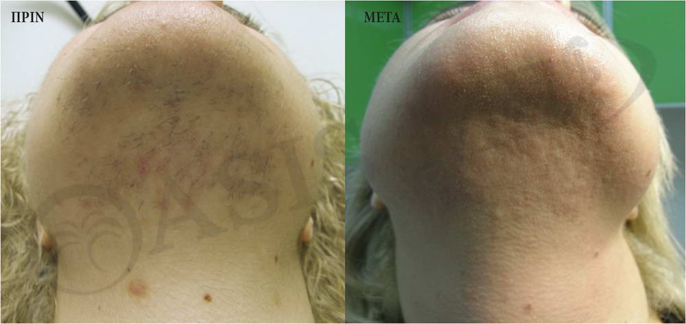 before after 9
