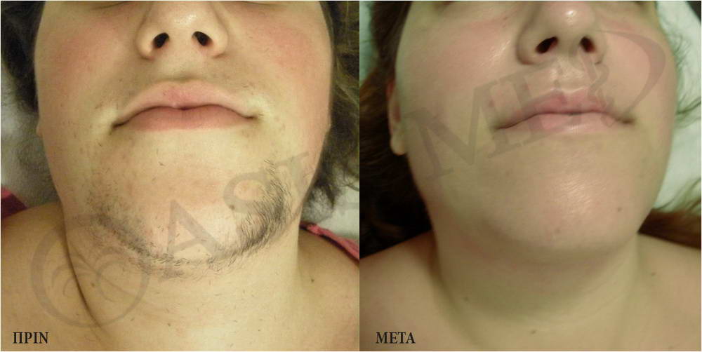 before after 10