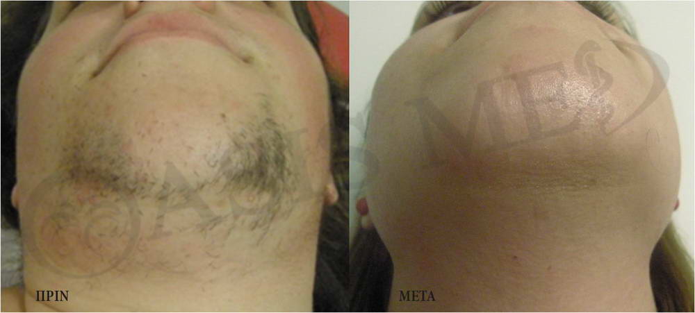 before after 12