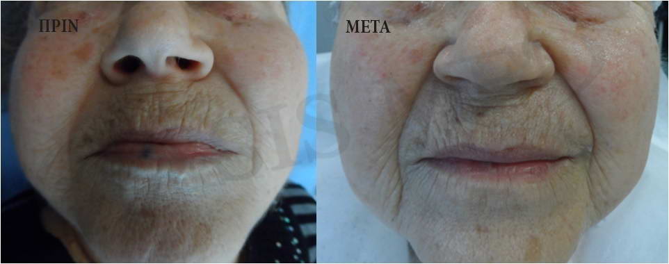 before after 10