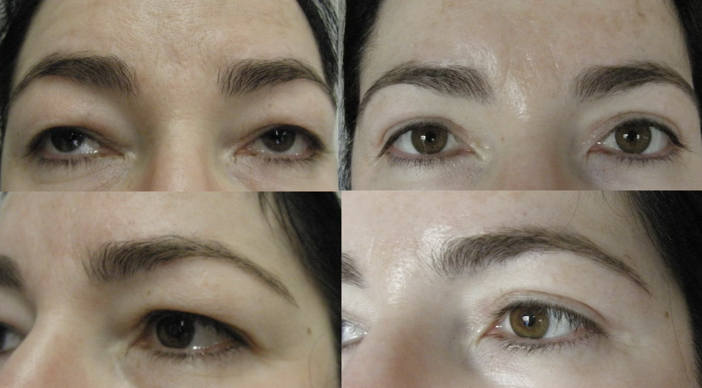 before after 0