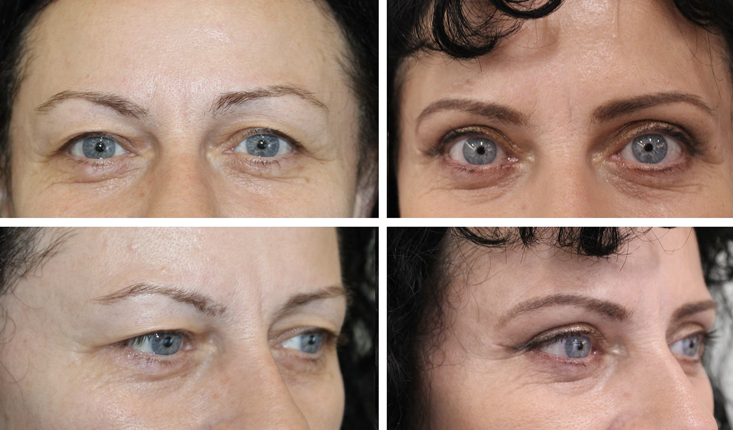 before after 1