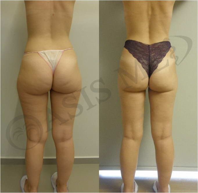 before after 21