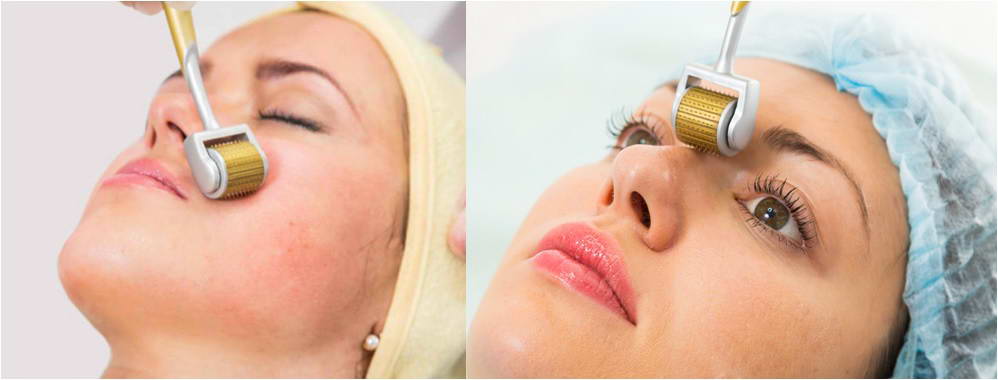 Συσκευή μη-ενέσιμης μεσοθεραπείας, Titanium MicroNeedle Dermaroller 2