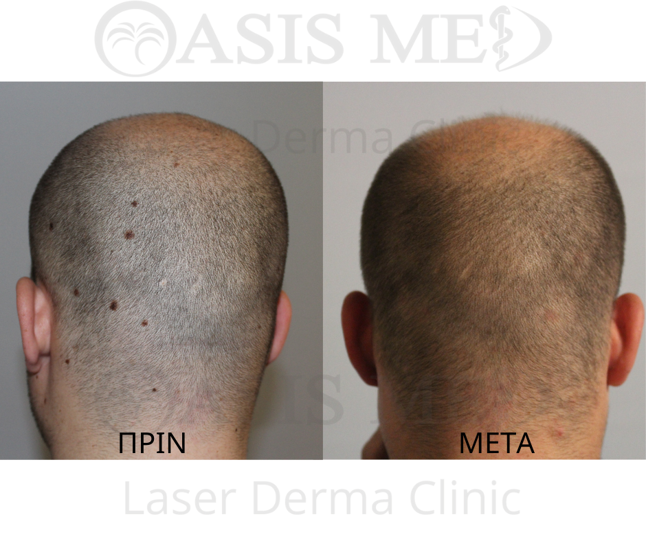 before after 23