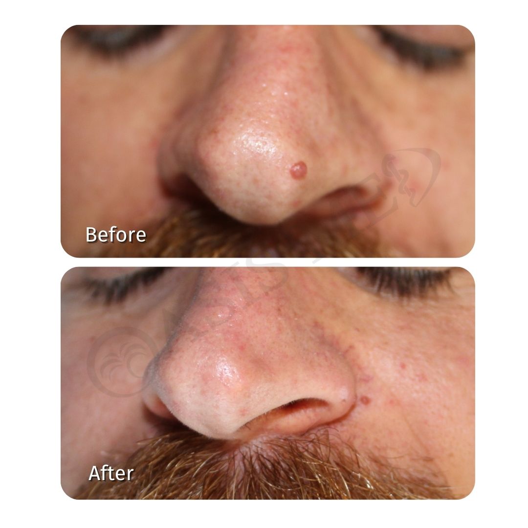 before after 25