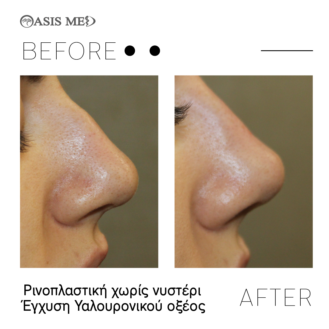 before after 9