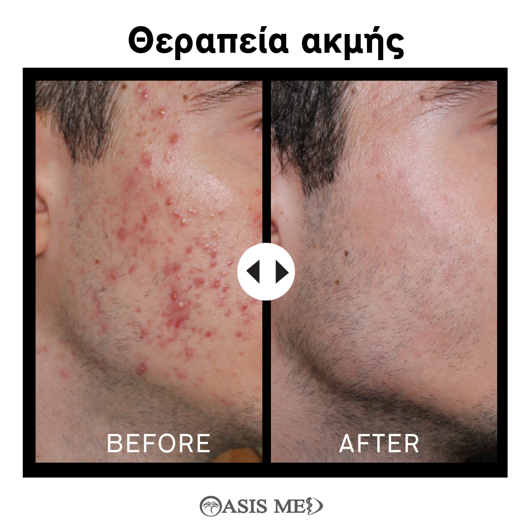 before after 0