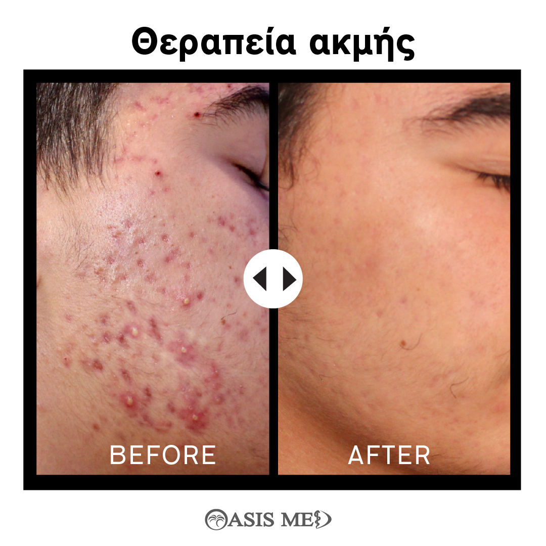 before after 1