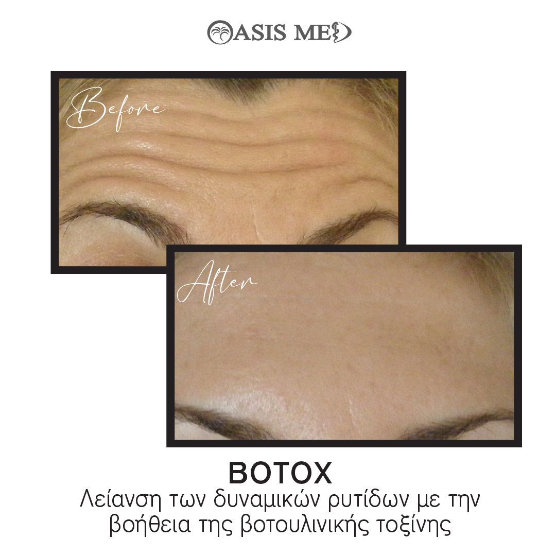 before after 10