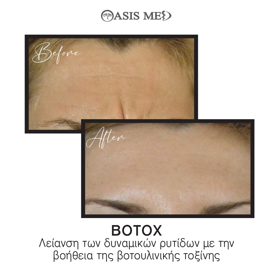 before after 11