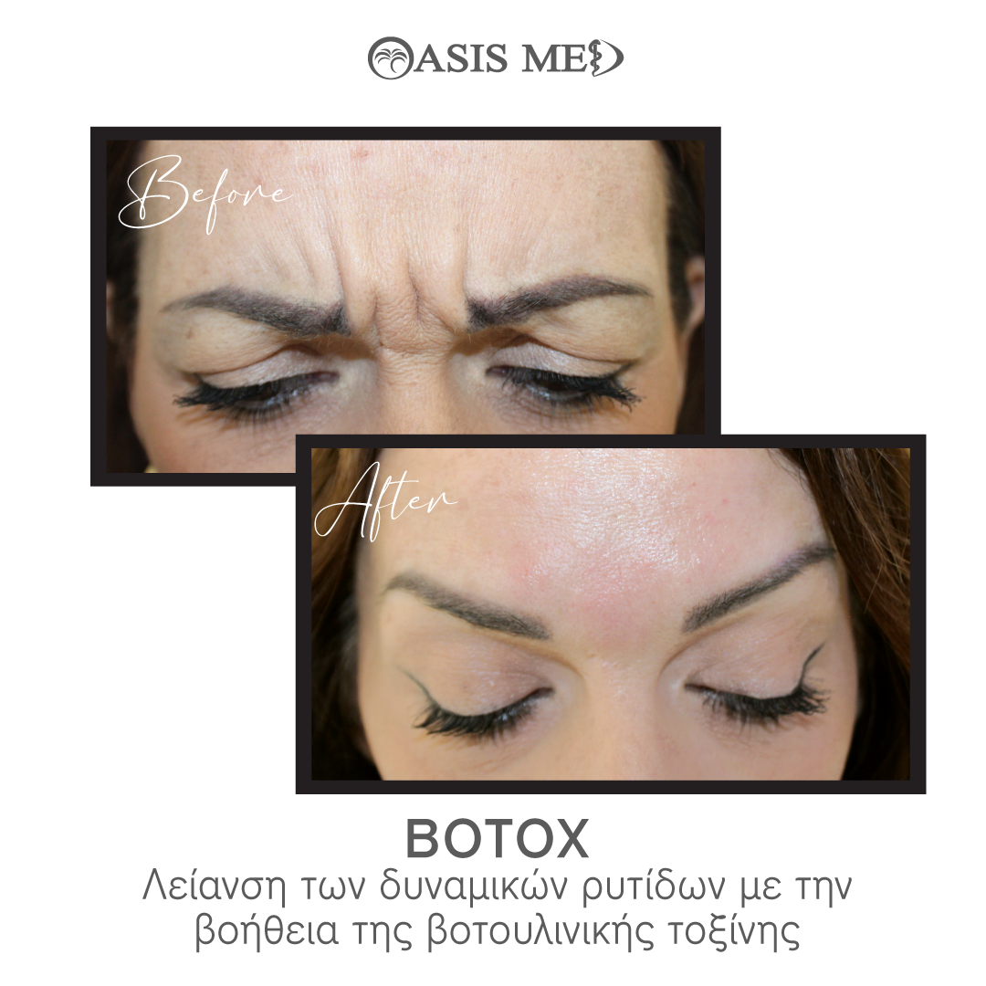 before after 13