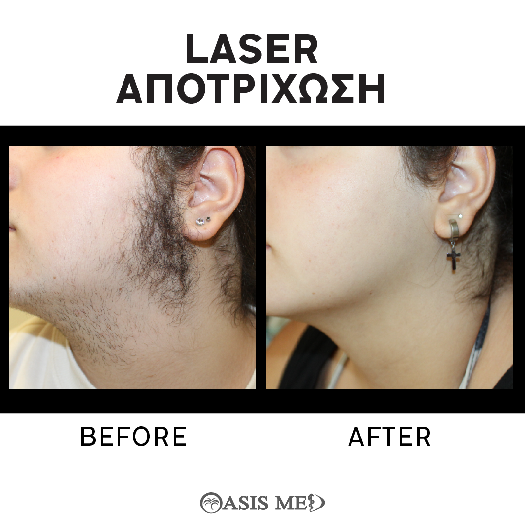 before after 0