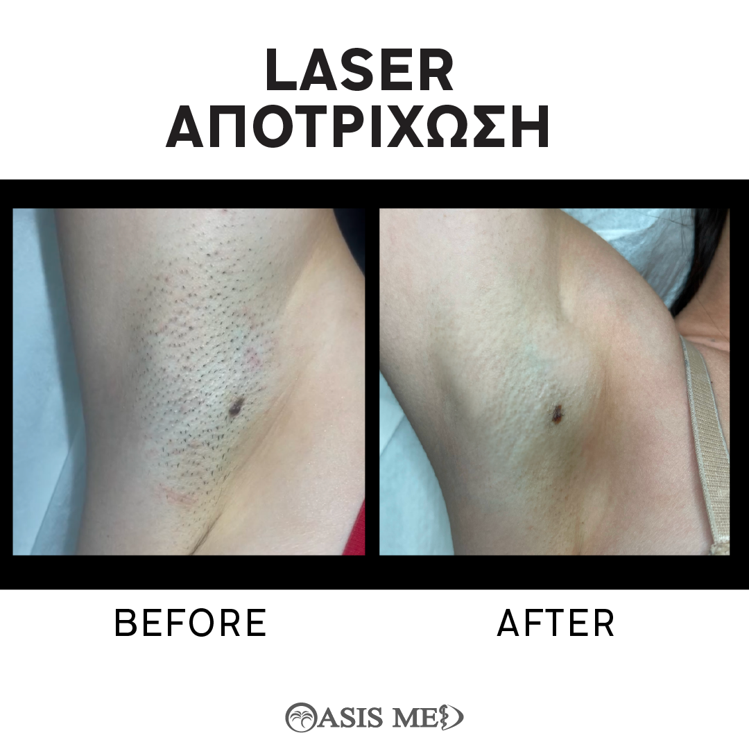 before after 1
