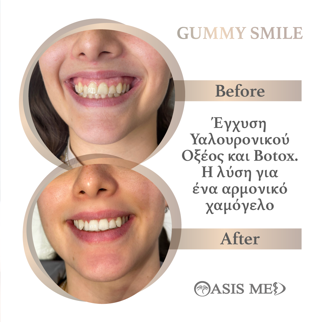 before after 4