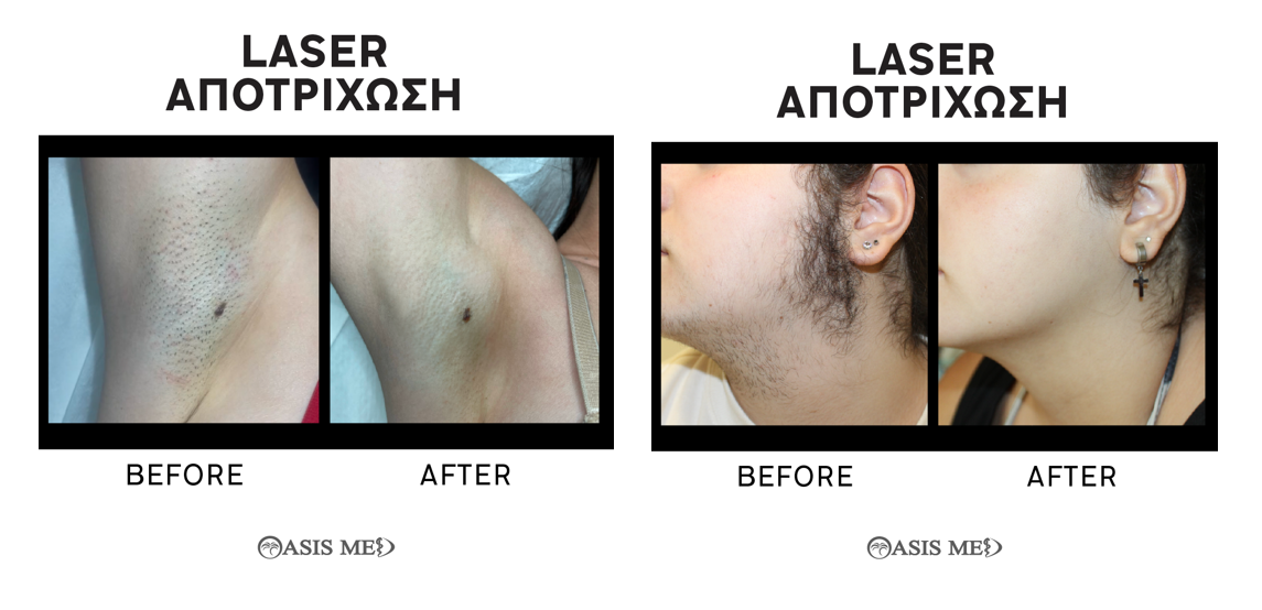 Αποτρίχωση LASER Alexandrite στην OASIS MED 3